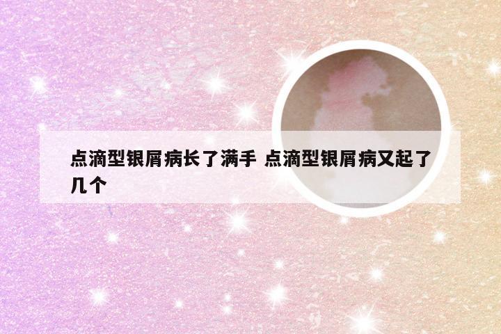 点滴型银屑病长了满手 点滴型银屑病又起了几个