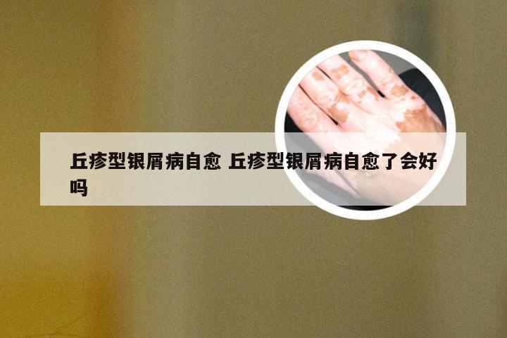 丘疹型银屑病自愈 丘疹型银屑病自愈了会好吗