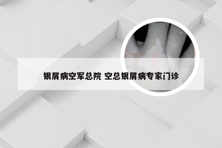 银屑病空军总院 空总银屑病专家门诊