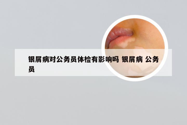 银屑病对公务员体检有影响吗 银屑病 公务员