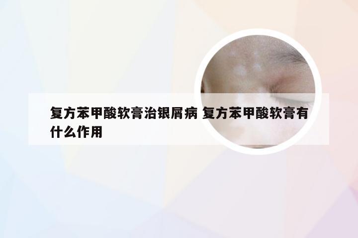 复方苯甲酸软膏治银屑病 复方苯甲酸软膏有什么作用