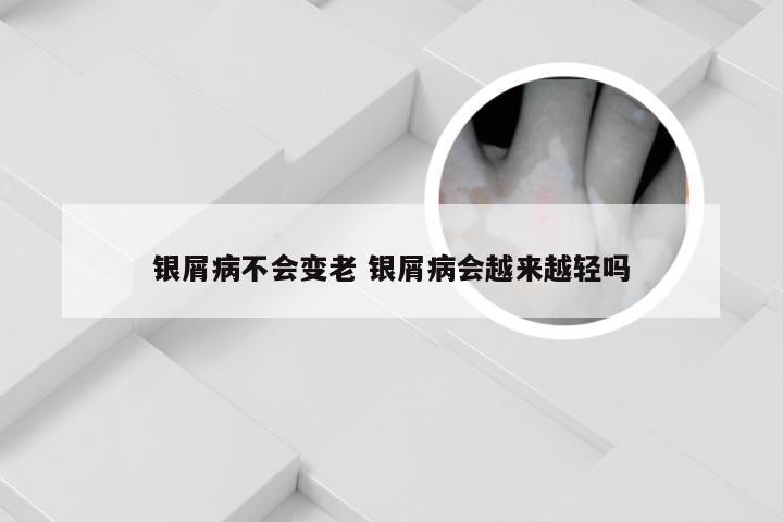 银屑病不会变老 银屑病会越来越轻吗