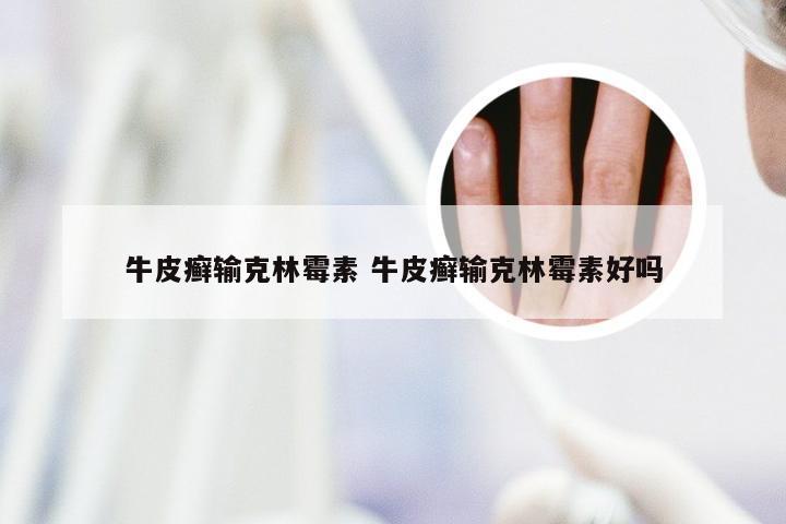 牛皮癣输克林霉素 牛皮癣输克林霉素好吗
