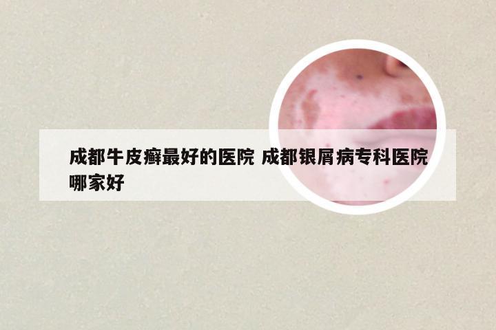 成都牛皮癣最好的医院 成都银屑病专科医院哪家好