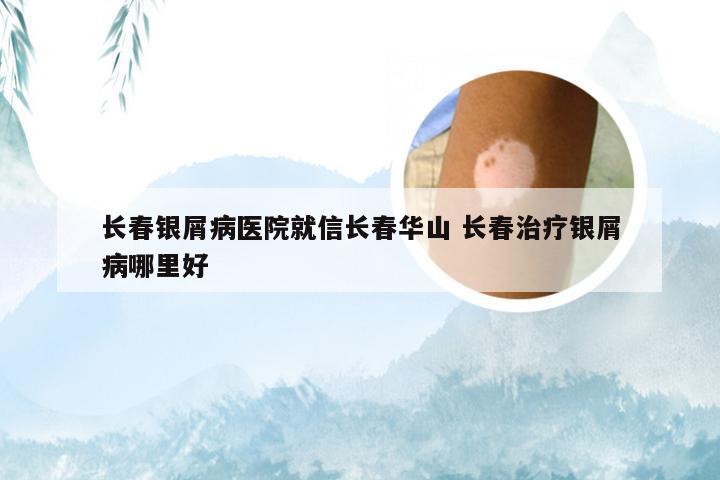 长春银屑病医院就信长春华山 长春治疗银屑病哪里好