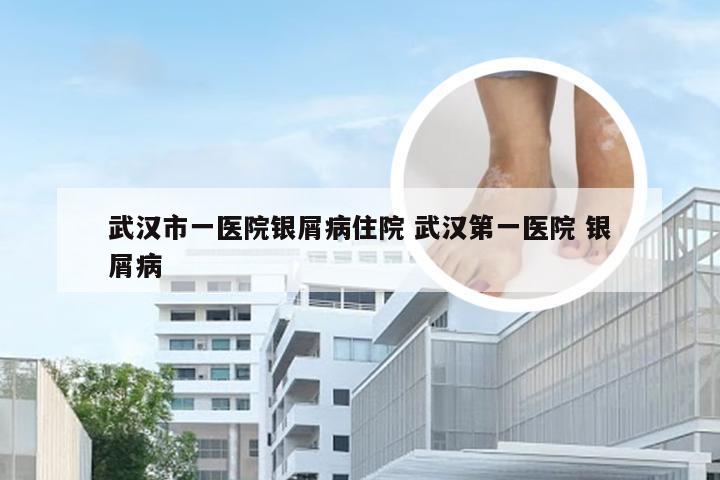 武汉市一医院银屑病住院 武汉第一医院 银屑病