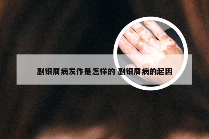 副银屑病发作是怎样的 副银屑病的起因