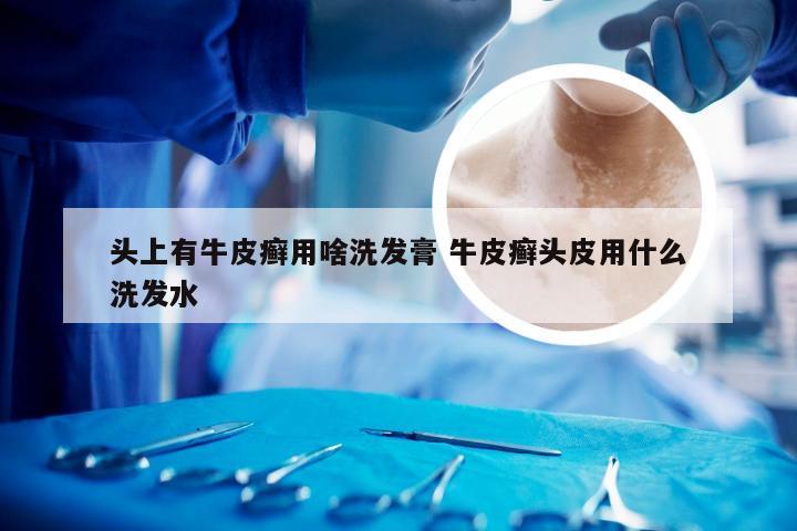 头上有牛皮癣用啥洗发膏 牛皮癣头皮用什么洗发水