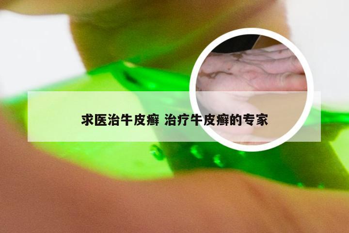 求医治牛皮癣 治疗牛皮癣的专家