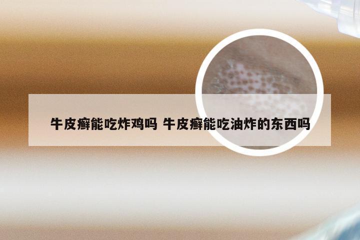 牛皮癣能吃炸鸡吗 牛皮癣能吃油炸的东西吗