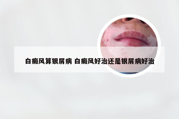 白癜风算银屑病 白癜风好治还是银屑病好治