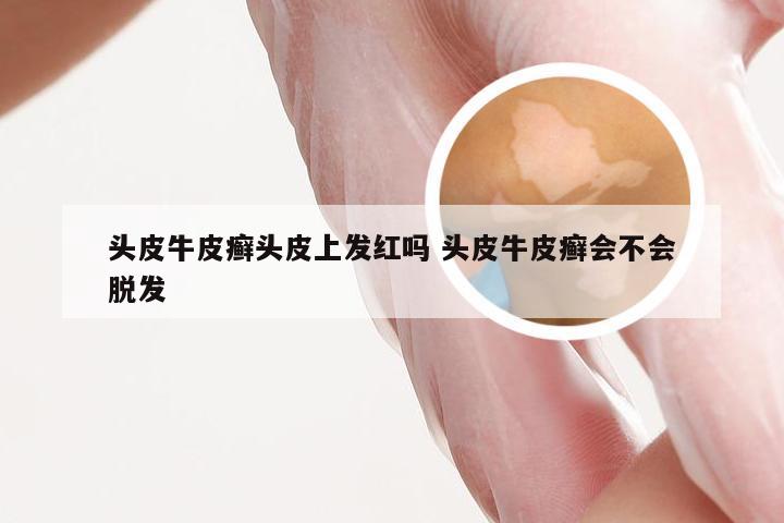 头皮牛皮癣头皮上发红吗 头皮牛皮癣会不会脱发