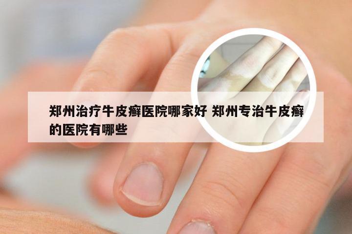 郑州治疗牛皮癣医院哪家好 郑州专治牛皮癣的医院有哪些