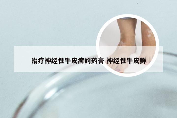 治疗神经性牛皮癣的药膏 神经性牛皮鲜