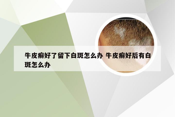 牛皮癣好了留下白斑怎么办 牛皮癣好后有白斑怎么办