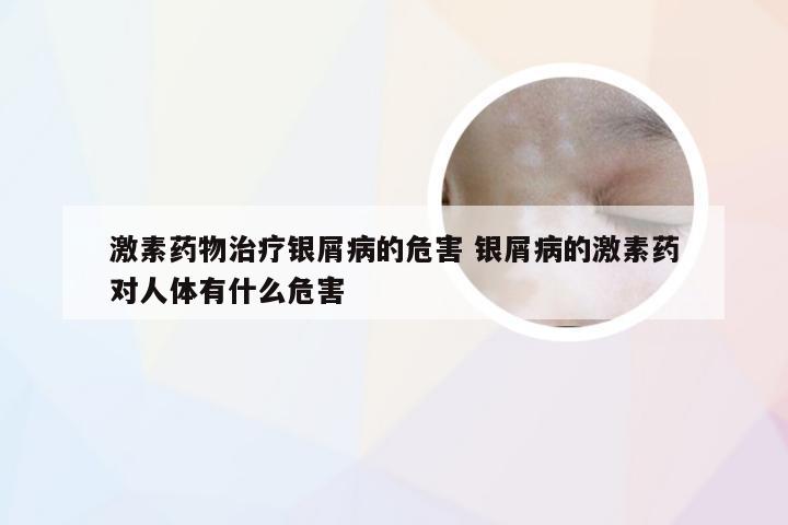 激素药物治疗银屑病的危害 银屑病的激素药对人体有什么危害