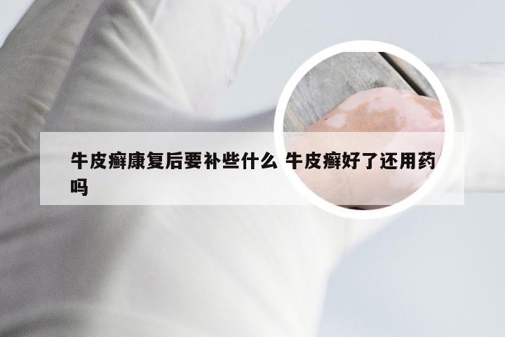 牛皮癣康复后要补些什么 牛皮癣好了还用药吗