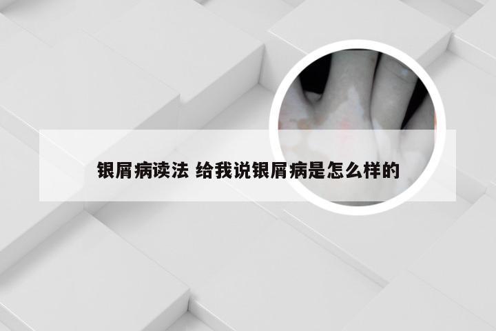 银屑病读法 给我说银屑病是怎么样的