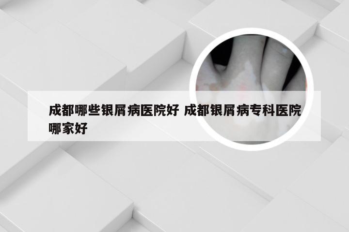 成都哪些银屑病医院好 成都银屑病专科医院哪家好