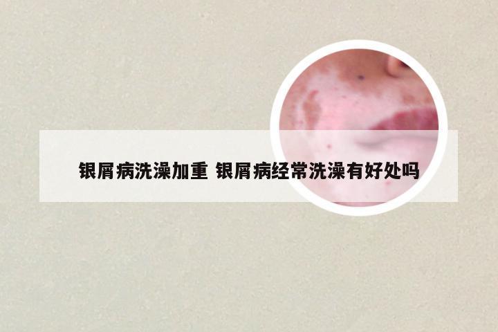银屑病洗澡加重 银屑病经常洗澡有好处吗