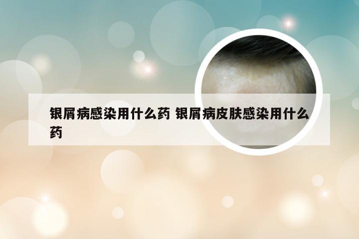银屑病感染用什么药 银屑病皮肤感染用什么药