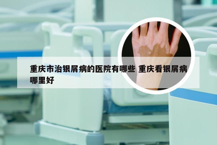 重庆市治银屑病的医院有哪些 重庆看银屑病哪里好