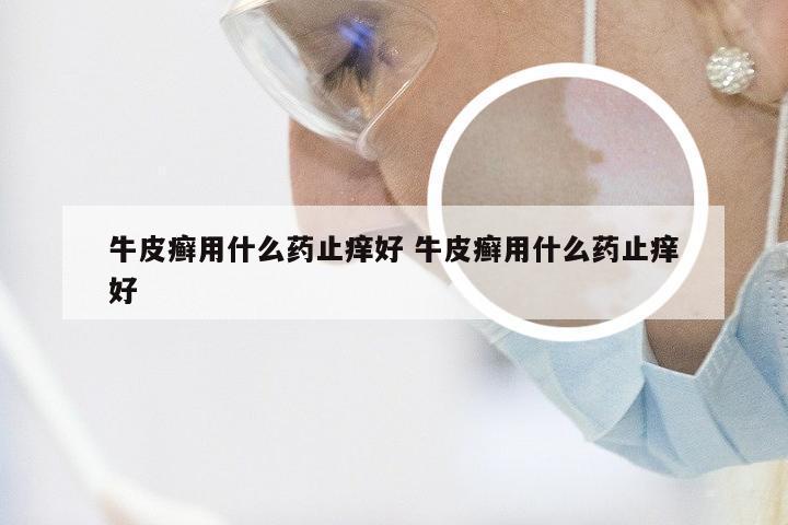 牛皮癣用什么药止痒好 牛皮癣用什么药止痒好