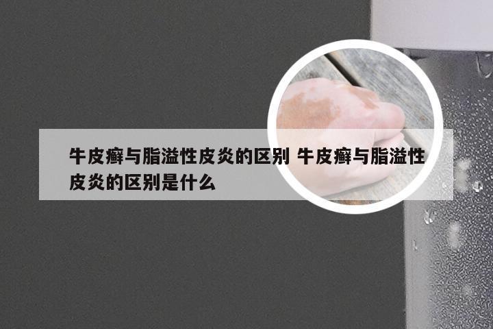 牛皮癣与脂溢性皮炎的区别 牛皮癣与脂溢性皮炎的区别是什么
