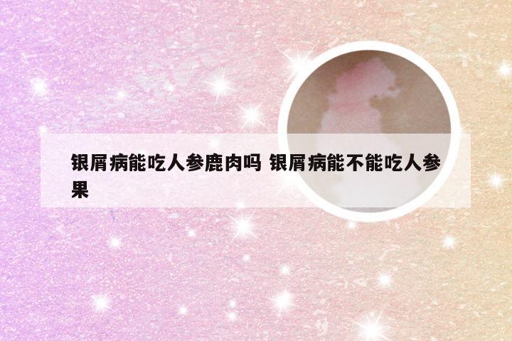 银屑病能吃人参鹿肉吗 银屑病能不能吃人参果
