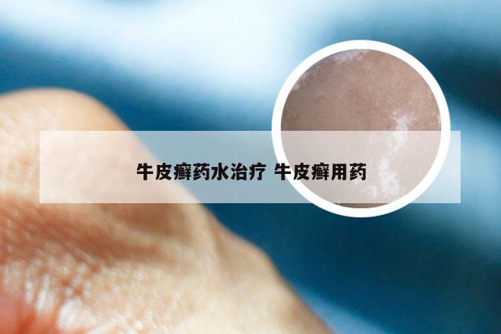 牛皮癣药水治疗 牛皮癣用药