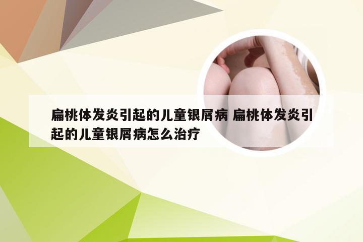 扁桃体发炎引起的儿童银屑病 扁桃体发炎引起的儿童银屑病怎么治疗