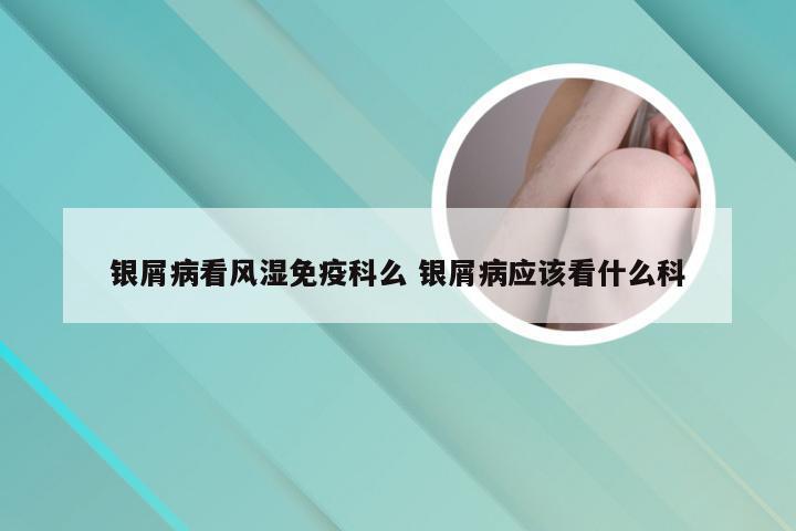 银屑病看风湿免疫科么 银屑病应该看什么科