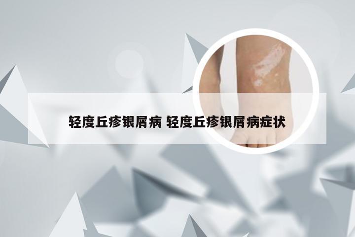 轻度丘疹银屑病 轻度丘疹银屑病症状