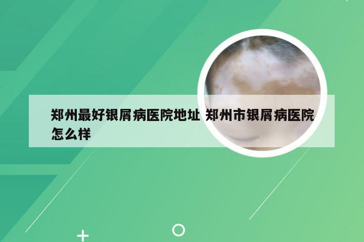 郑州最好银屑病医院地址 郑州市银屑病医院怎么样