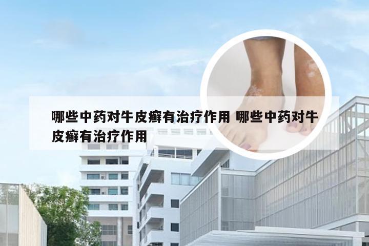 哪些中药对牛皮癣有治疗作用 哪些中药对牛皮癣有治疗作用