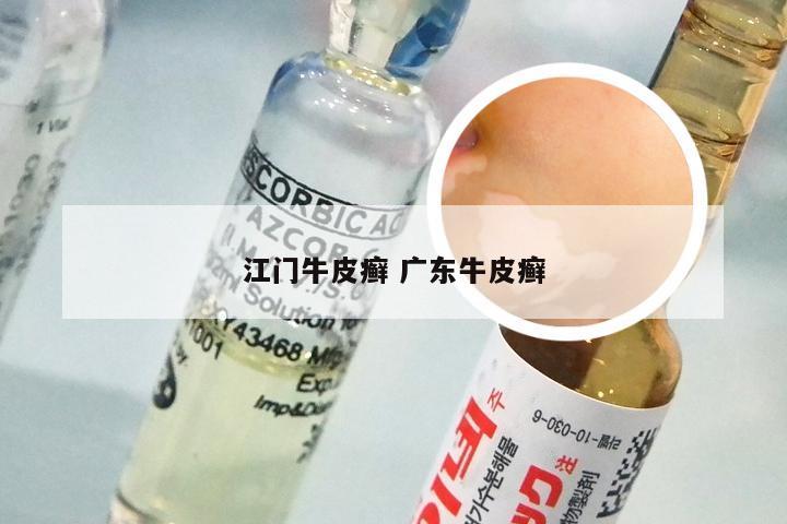 江门牛皮癣 广东牛皮癣