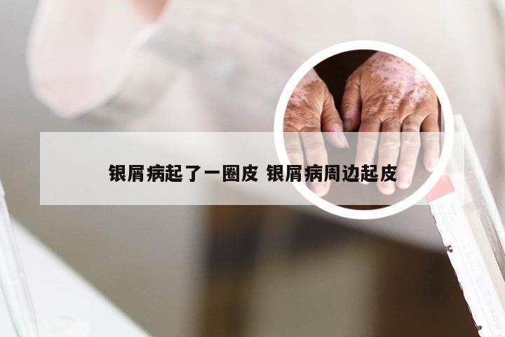 银屑病起了一圈皮 银屑病周边起皮