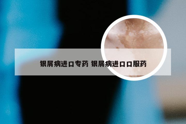 银屑病进口专药 银屑病进口口服药