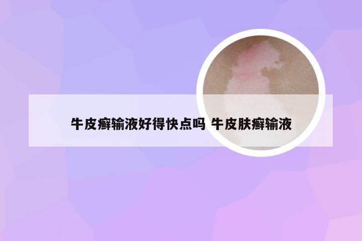 牛皮癣输液好得快点吗 牛皮肤癣输液
