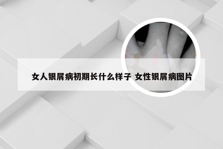 女人银屑病初期长什么样子 女性银屑病图片