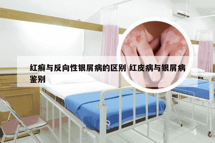 红癣与反向性银屑病的区别 红皮病与银屑病鉴别