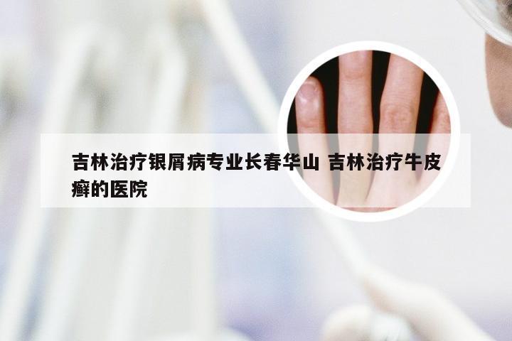 吉林治疗银屑病专业长春华山 吉林治疗牛皮癣的医院