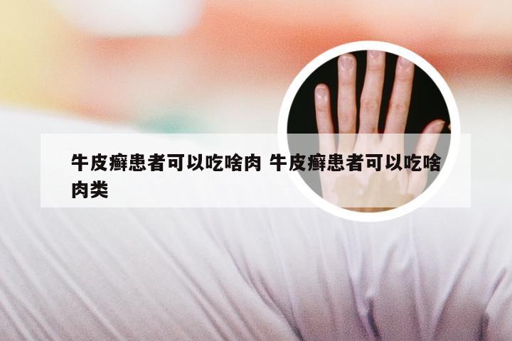 牛皮癣患者可以吃啥肉 牛皮癣患者可以吃啥肉类