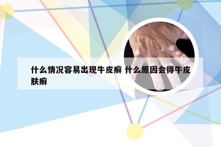 什么情况容易出现牛皮癣 什么原因会得牛皮肤癣