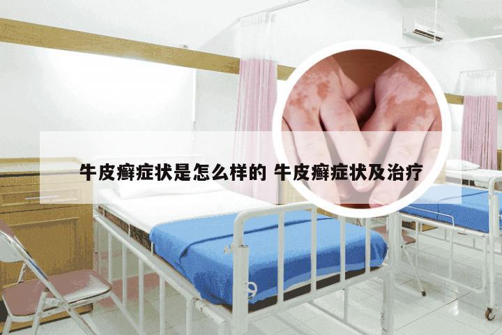 牛皮癣症状是怎么样的 牛皮癣症状及治疗