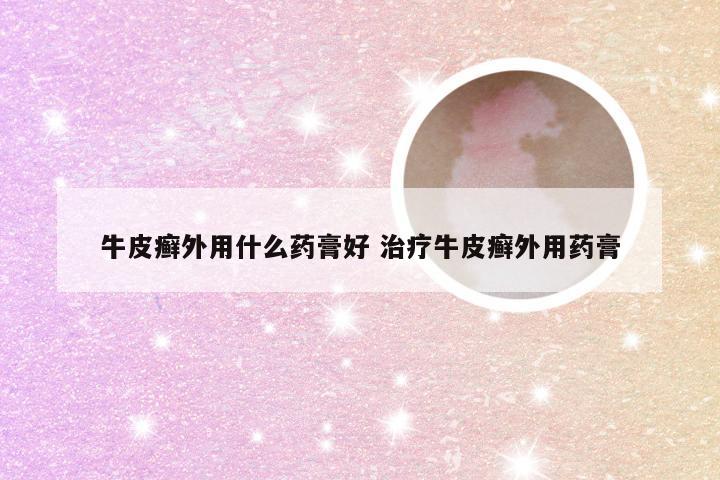 牛皮癣外用什么药膏好 治疗牛皮癣外用药膏