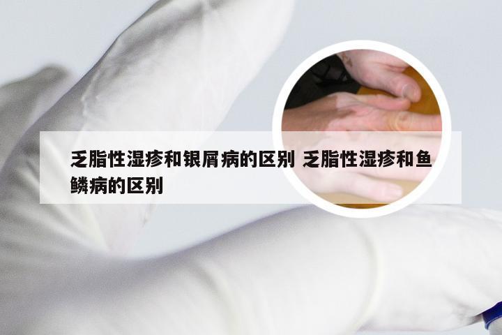 乏脂性湿疹和银屑病的区别 乏脂性湿疹和鱼鳞病的区别