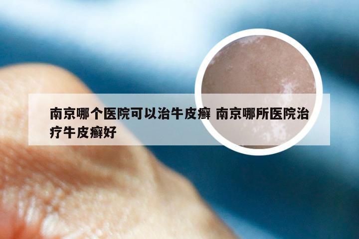 南京哪个医院可以治牛皮癣 南京哪所医院治疗牛皮癣好