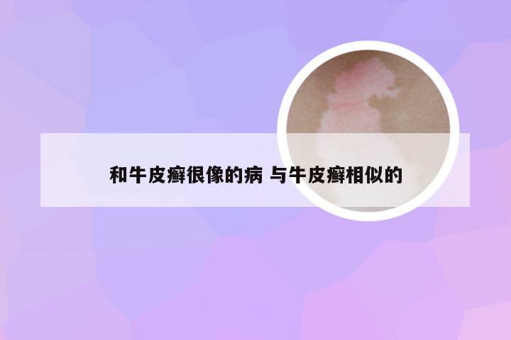 和牛皮癣很像的病 与牛皮癣相似的