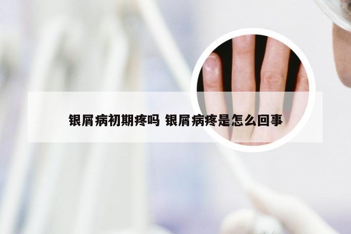 银屑病初期疼吗 银屑病疼是怎么回事